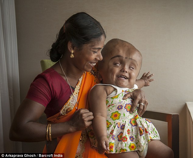 印度三岁小女孩患脑积水头是正常小孩头部的三倍