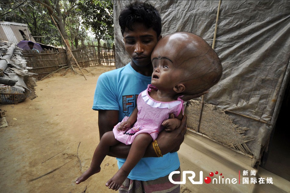 印度三岁小女孩患脑积水头是正常小孩头部的三倍
