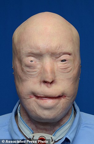 重获新生！美国毁容消防员成功接受史上最强换脸术