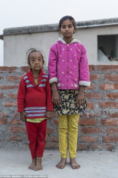 印度年幼姐弟患早衰症似古稀老人 父母贫寒无力海外求医