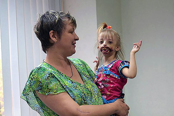 俄夫妻竭力拯救鬼面女儿术后有明显好转