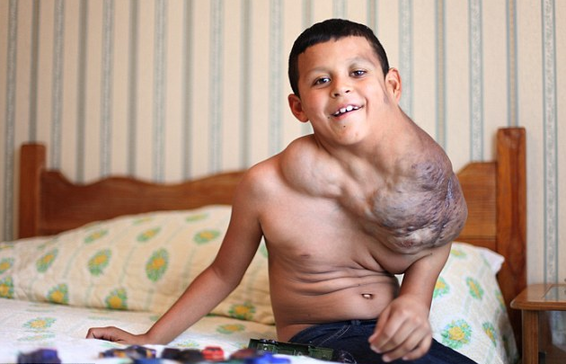 墨10岁儿童颈部长巨瘤 吃“伟哥”或可缩小切除