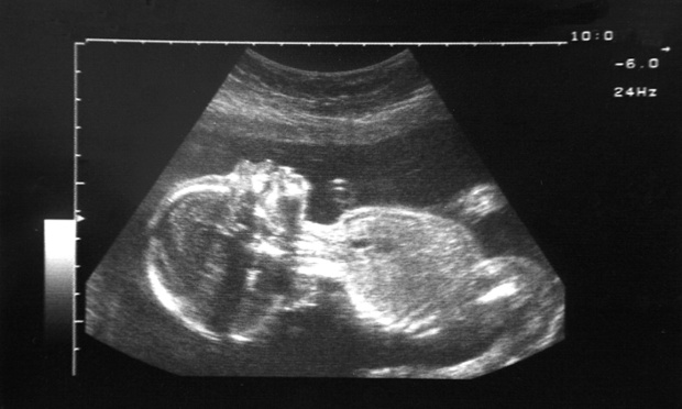 研究称女性胎儿比男性更易胎死腹中